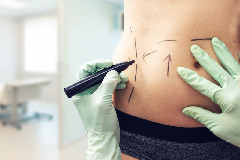woman's body being marked up before abdominoplasty procedure