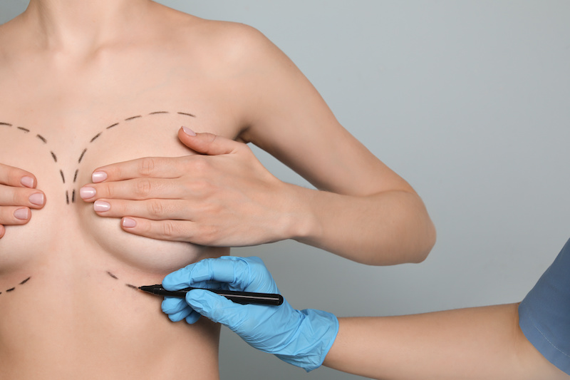 woman's body being marked up before breast augmentation procedure