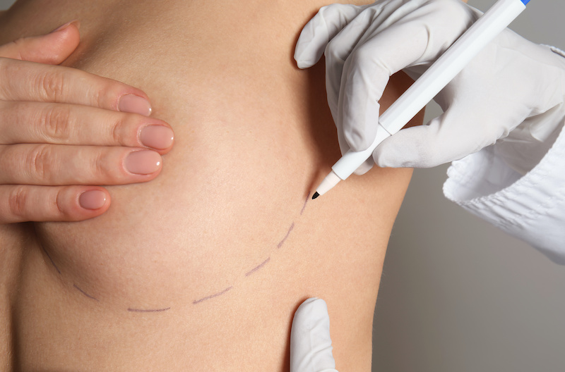 woman's body being marked up before breast reconstruction procedure