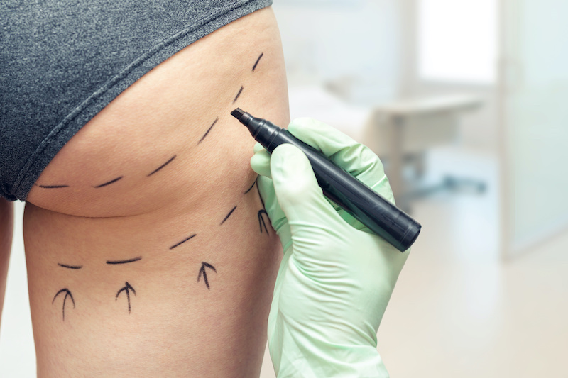 woman's body being marked up before liposuction procedure