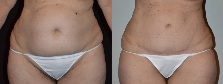 Reverse Abdominoplasty before and after image