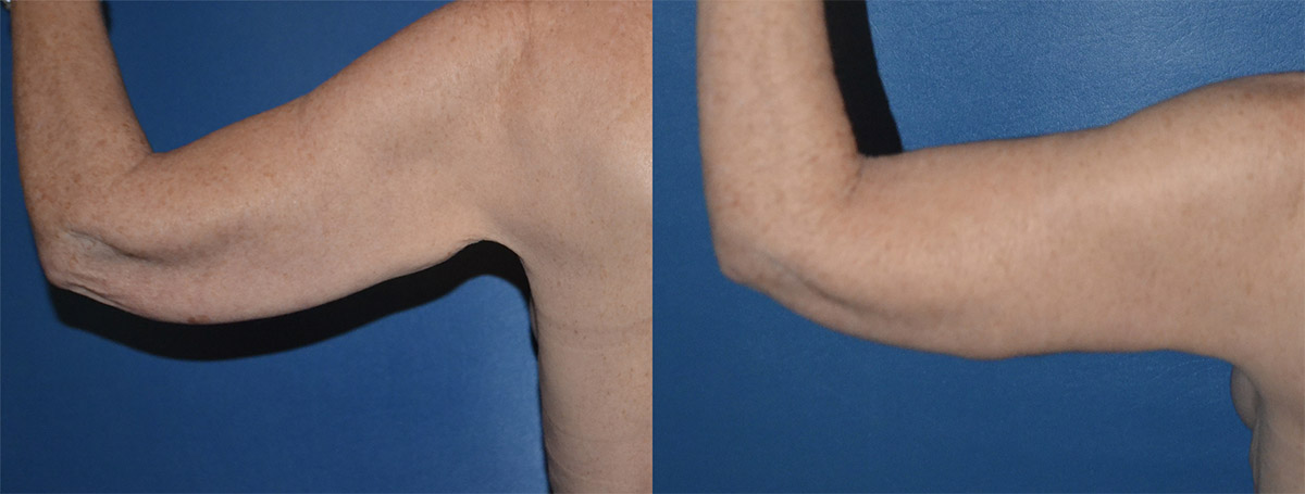 Brachioplasty before and after images