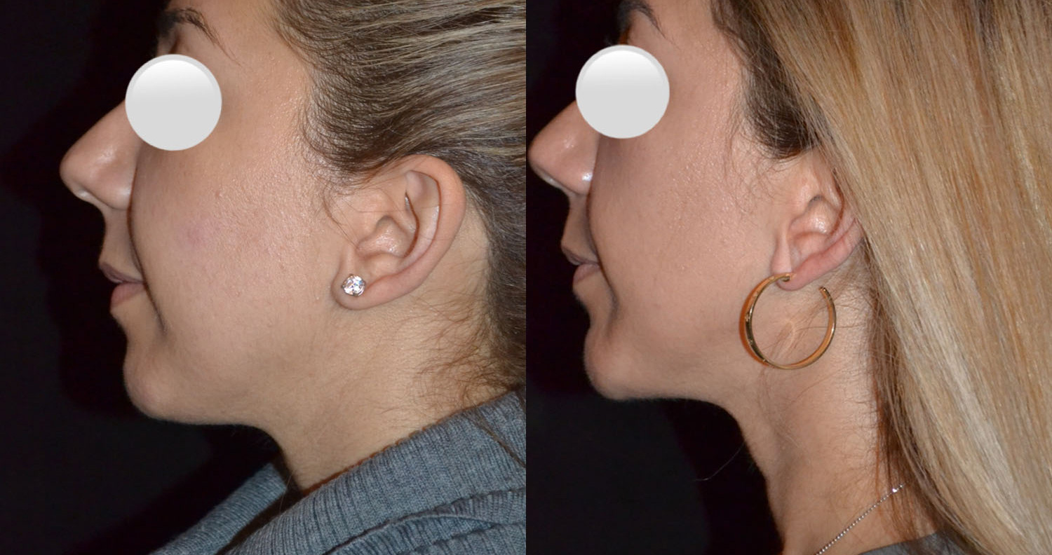 Chin Augmentation before and after images performed at Renaissance Plastic Surgery