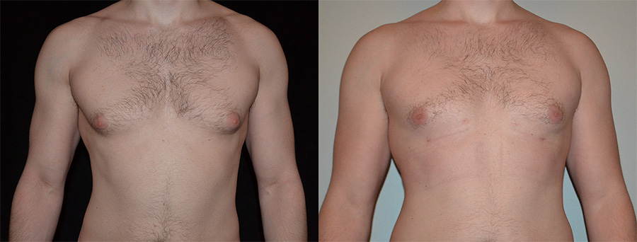Gynecomastia before and after image